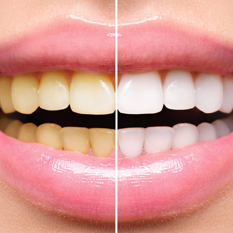 Clareamento Dental